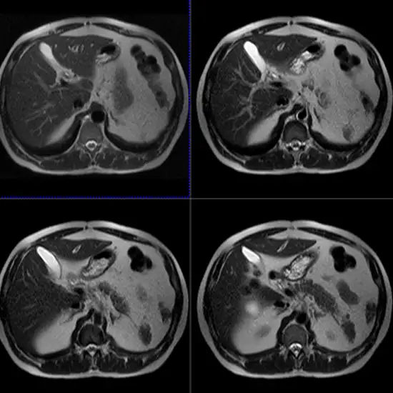 MRI Whole Abdomen and MRCP